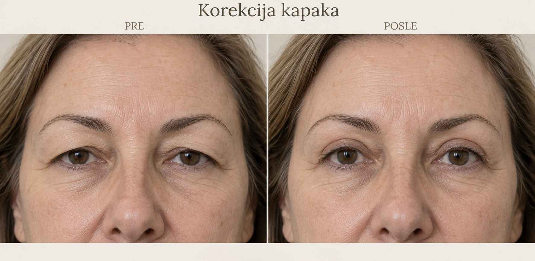 AI ilustracija korekcije kapaka, poređenje pre i posle; nije stvarni pacijent
