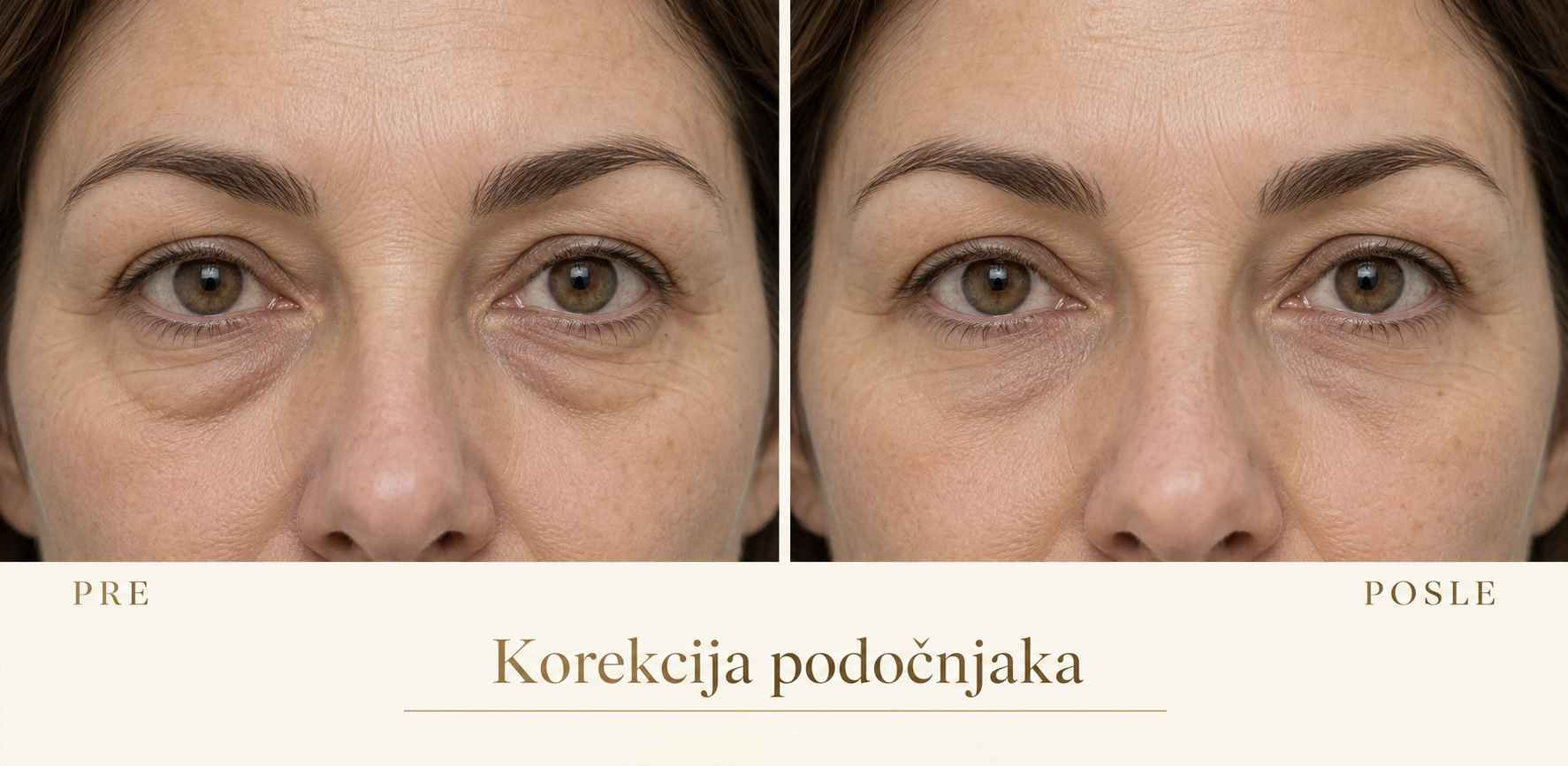 AI ilustracija korekcije podočnjaka, poređenje pre i posle; nije stvarni pacijent